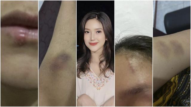 Bukti Adelia Septa lebam-lebam. Foto: Instagram/ @adeliasepta